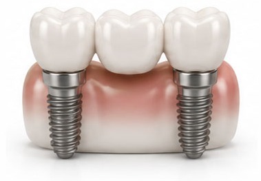 Puente sobre implantes